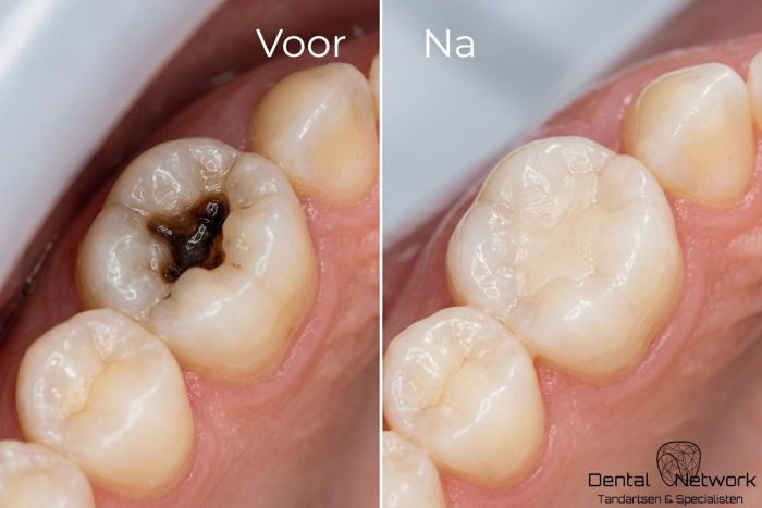 Vergelijking van een kies met een gaatje (voor de behandeling) met rechts dezelfde kies na het gaatje vullen