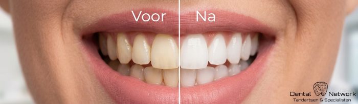 Lachende vrouw die lacht met links haar tanden voor een tanden bleken behandeling, rechts haar tanden ná een tanden bleek behandeling